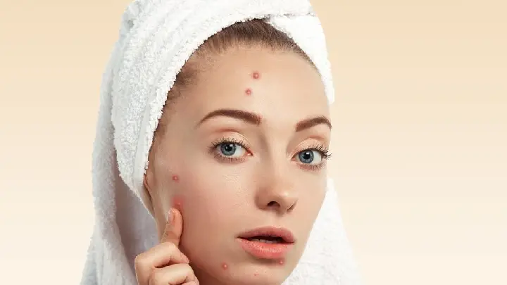 Acne Scars: Prevention and Treatment Options for Healthy Skin