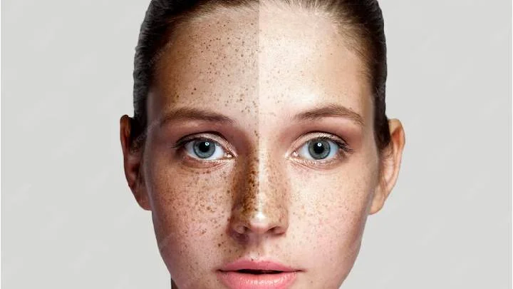 Can I Get Rid of Freckles Naturally? Try These Home Solutions