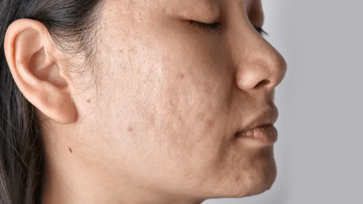 Understanding Acne Scars: Causes, Types, and Effective Treatments