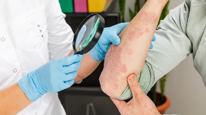 Psoriasis: What It Is, Symptoms, Causes, Types & Treatment