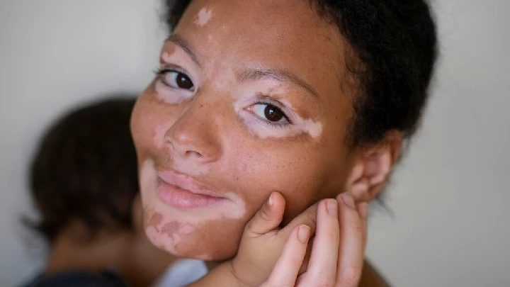 Vitiligo: Types, Symptoms, Causes, Treatment & Recovery