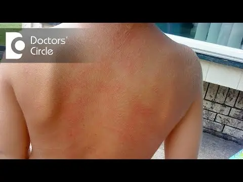 Urticaria