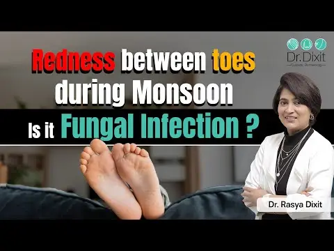 How to Treat Fungal Infection between Toes? | Fungal Infection in Rainy Season