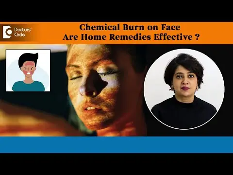 CHEMICAL BURN on Face -Are Home Remedies Effective?| Skin Care Tips-Dr.Rasya Dixit