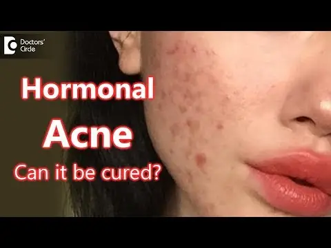 Hormonal Acne be cured