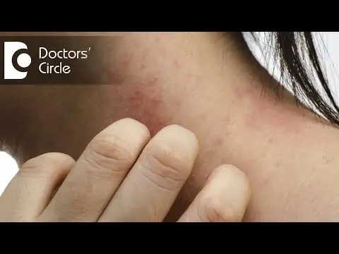 Eczema