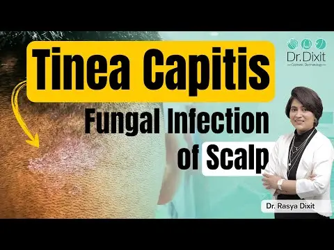 Fungal infection in hair scalp treatment | Tinea capitis scalp |fungal infection treatment,bangalore