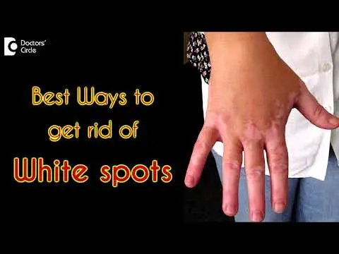 Vitiligo Treatment