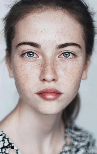 Facial pigmentation and Melasma