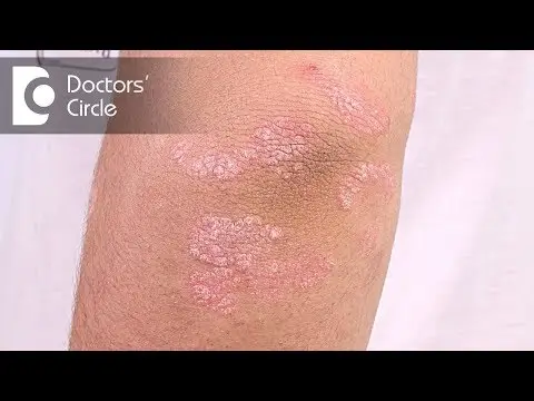 Psoriasis