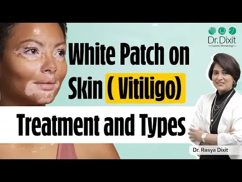 White Patches on Skin | Vitiligo Skin Disease Treatment | Types of vitiligo